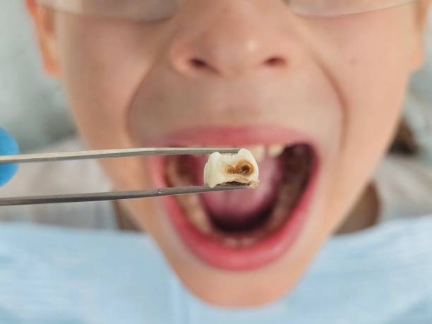 Best Emergency Wisdom Teeth Removal in Moorestown Lenola, NJ